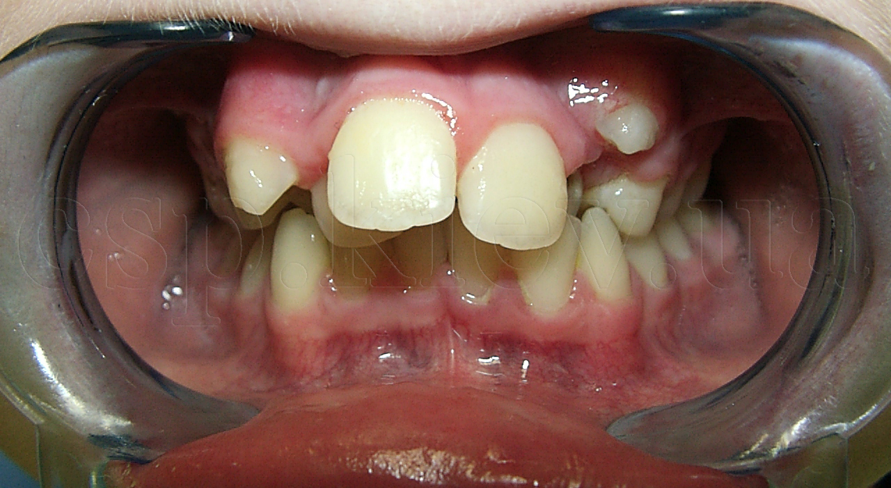 Ортодонтическая терапия