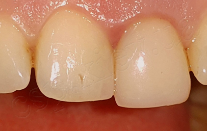 Одномоментна імплантація в лунку видаленого 21 зуба з негайним тимчасовим протезуванням(дентальний імплант Megagen, тимчасова коронка - власний зуб)