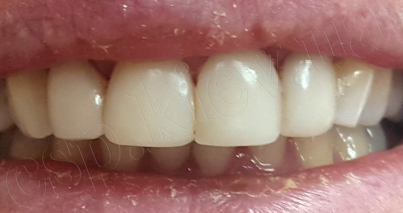Реставрация зубов фотополимерным материалом Gradia