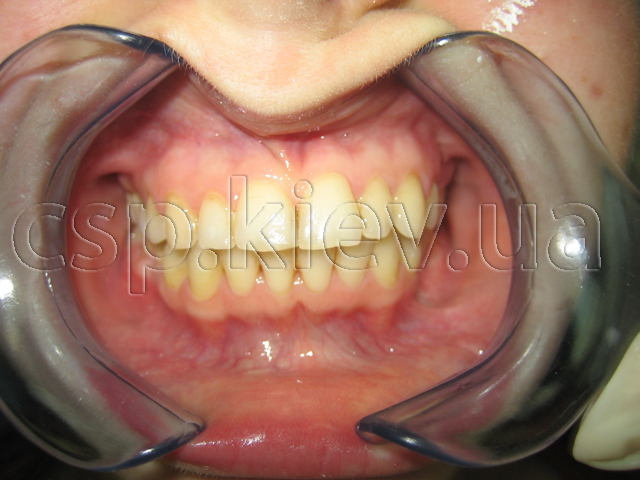 Скупченість зубів верхньої та нижньої щелепи, адентія (відсутність) зачатків других премолярів на нижній щелепі