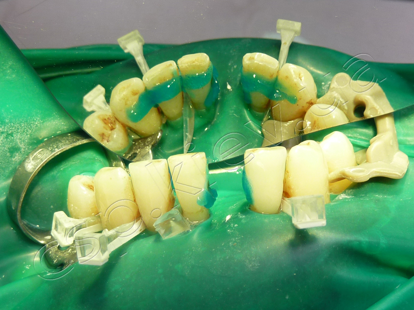 Улучшение гигиены полости рта у пациентов с распространенным пародонтитом при иммобилизации подвижных зубов с использованием армирующих волоконных систем