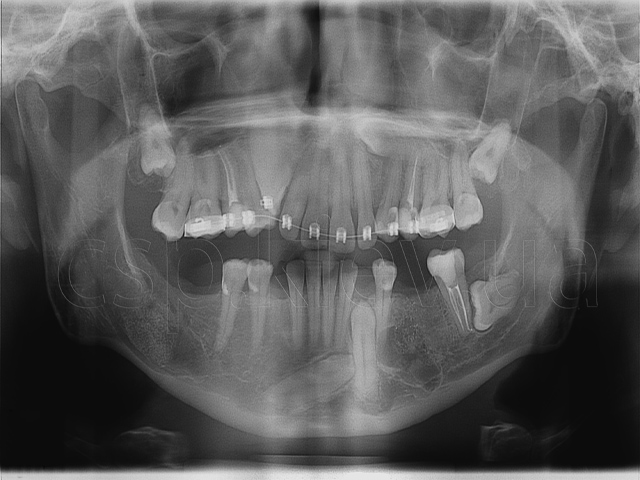Комплексное ортодонтическое лечение при наличии у пациентов ретенированных зубов