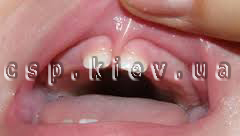 Подрезание уздечек верхней губы, нижней губы, языка